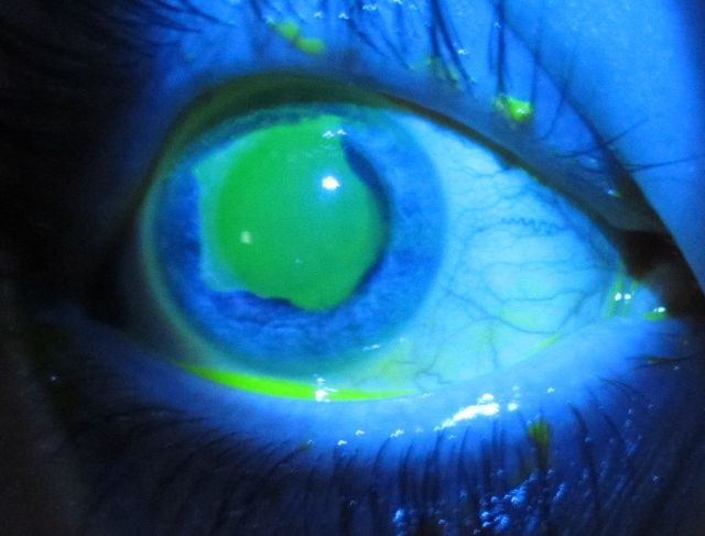 Photograph of eyelid trauma: A close-up image showing an injured eyelid.